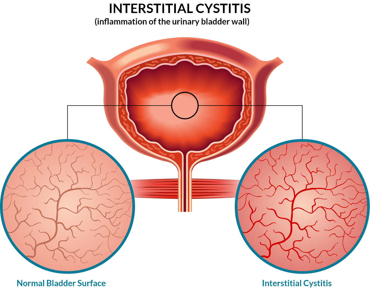 Interstitial Cystitis